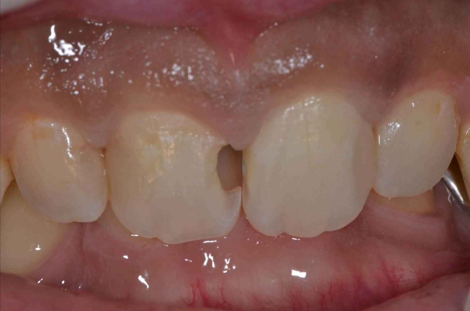 歯肉の中にまでおよぶ虫歯の治療 | 赤坂の歯医者｜赤坂デンタル