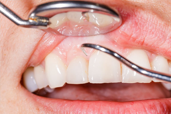 歯周外科の症例