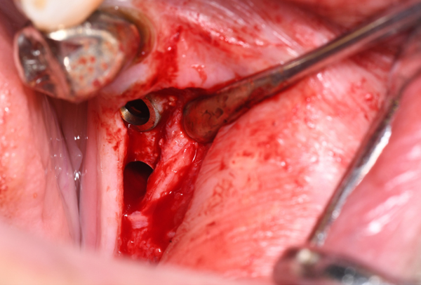 赤坂デンタルオフィスの歯周外科