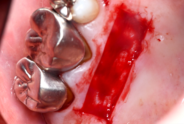 赤坂デンタルオフィスの歯周外科