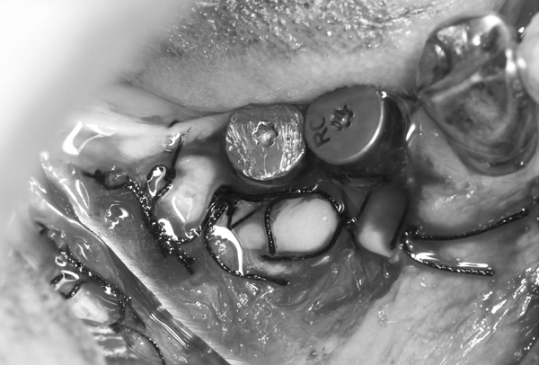 赤坂デンタルオフィスの歯周外科