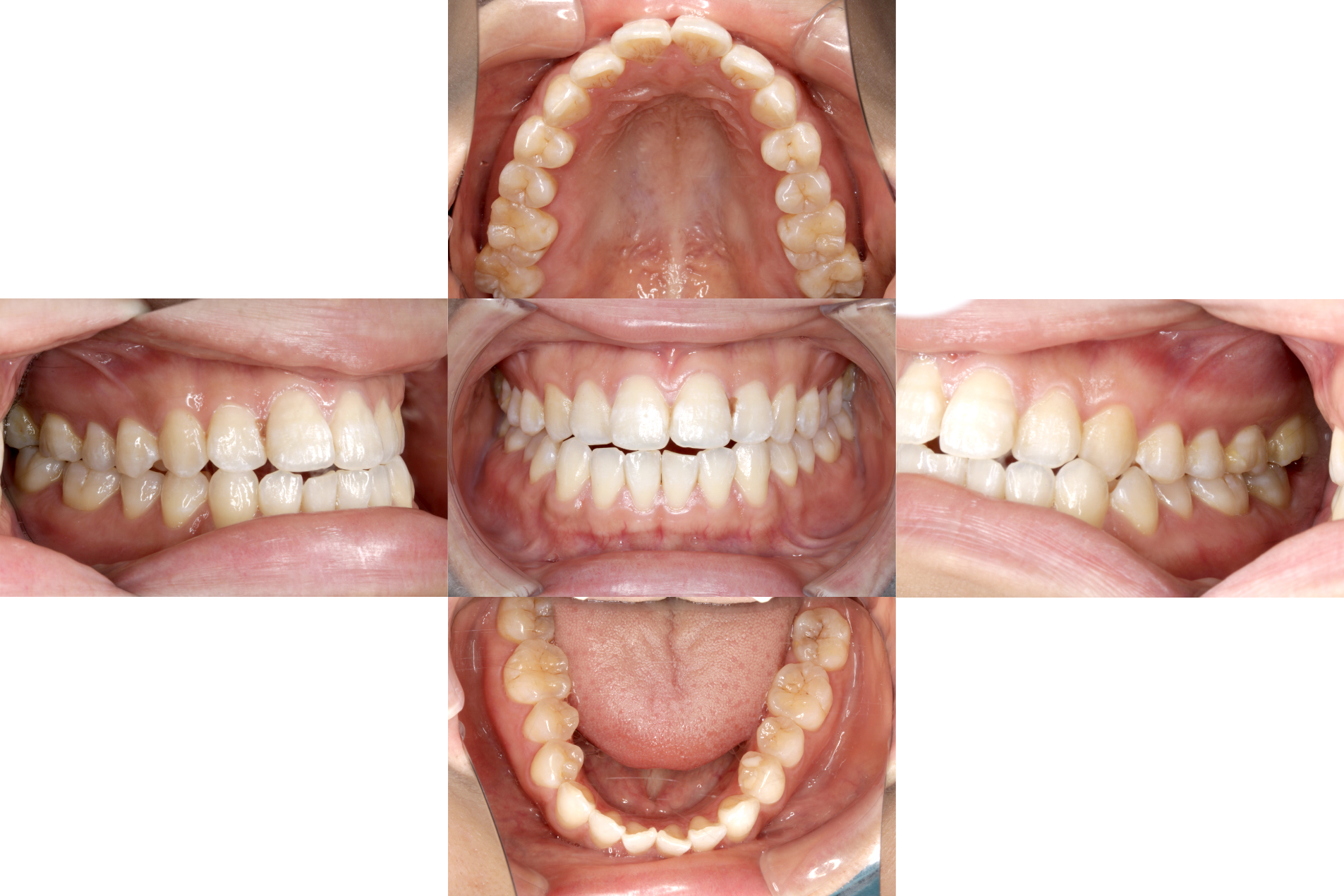 赤坂デンタルオフィスのインプラント