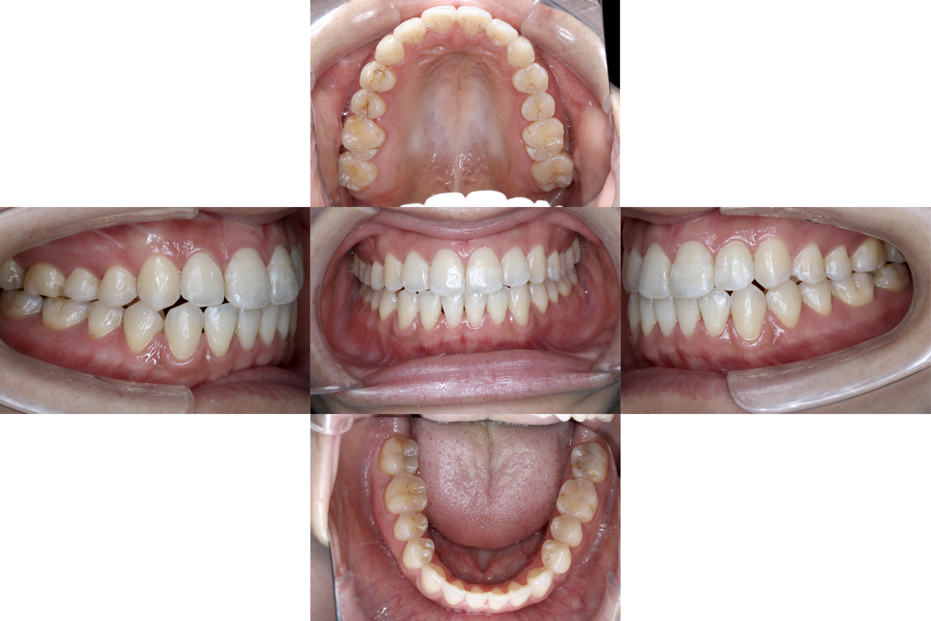 赤坂デンタルオフィスのインプラント