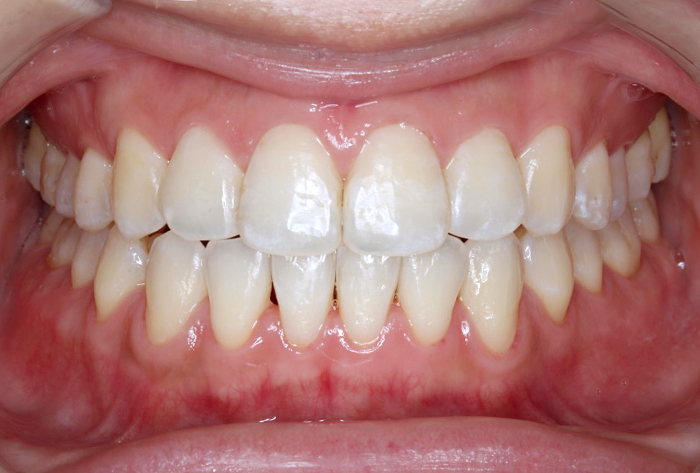 赤坂デンタルオフィスのインプラント