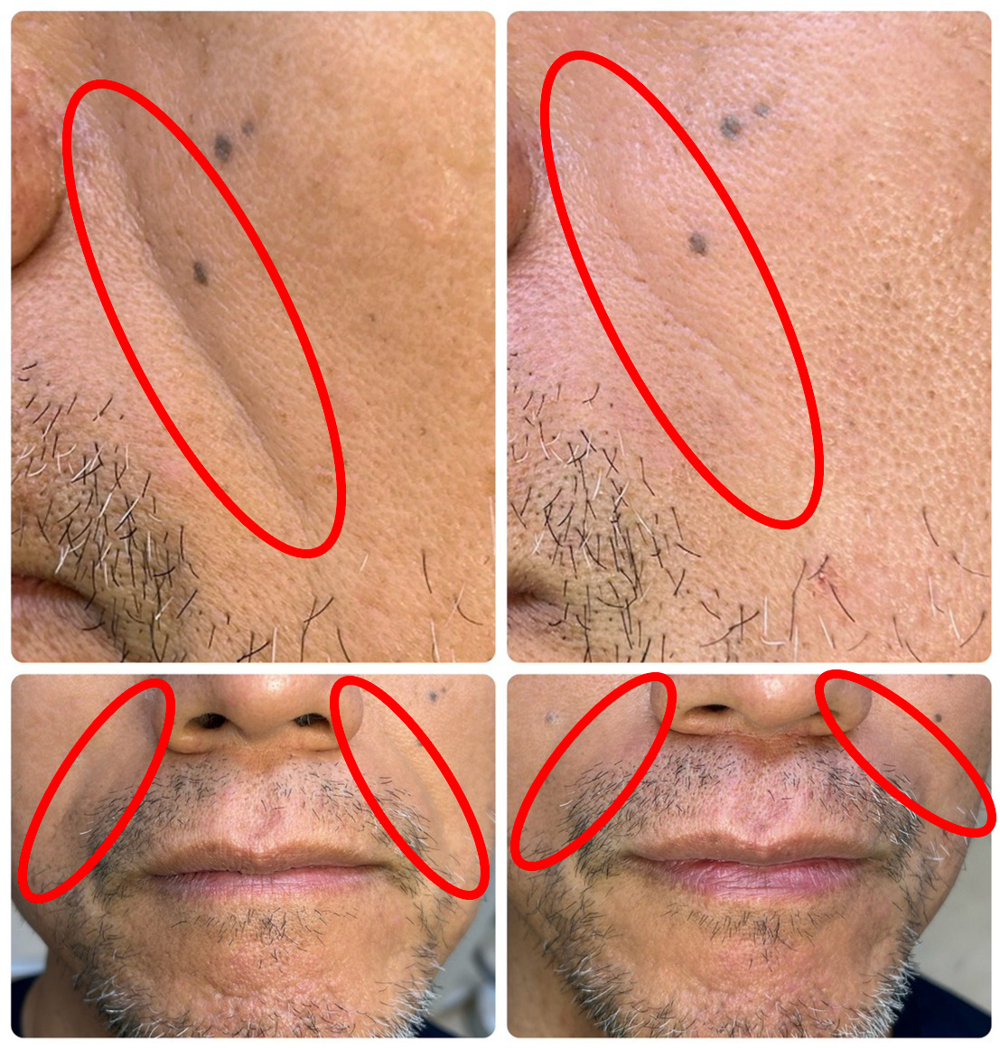 ヒアルロン酸注入によるほうれい線治療の症例.1