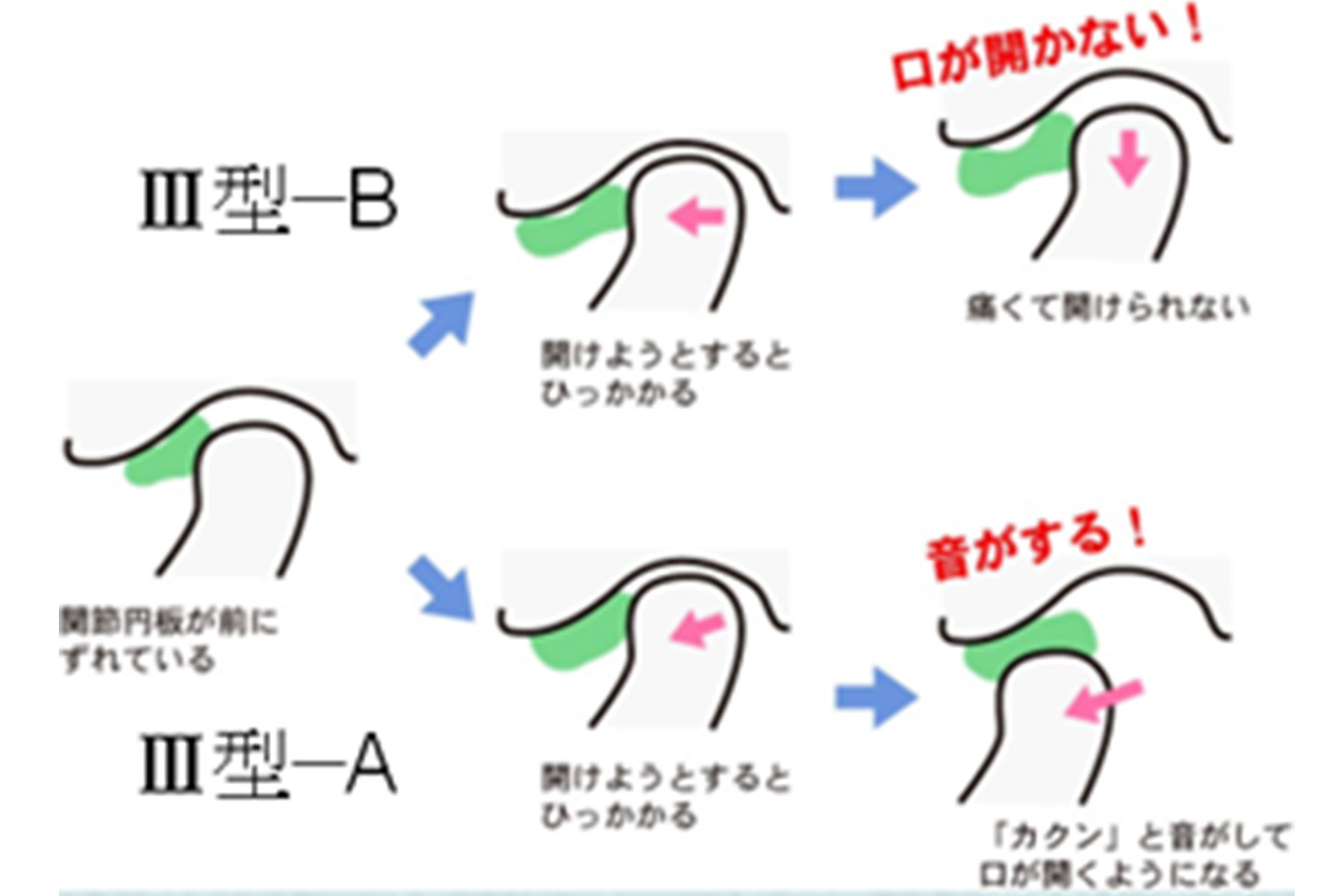 顎関節症