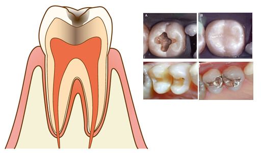 赤坂デンタルオフィスの虫歯治療