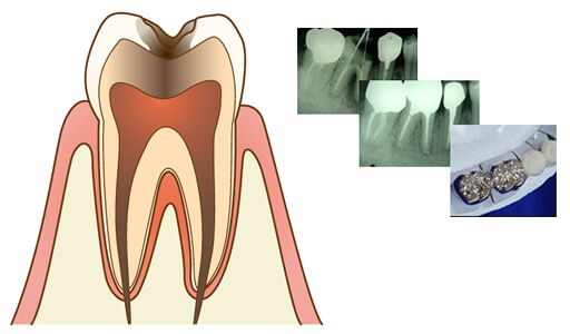 赤坂デンタルオフィスの虫歯治療