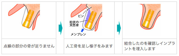 赤坂デンタルオフィスのインプラント