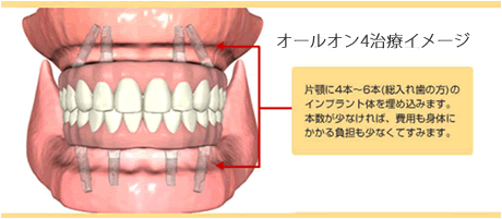 赤坂デンタルオフィスのインプラント