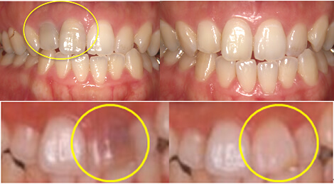 赤坂デンタルオフィスのホワイトニング